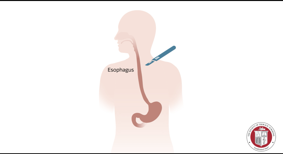 esophagectomy drawing