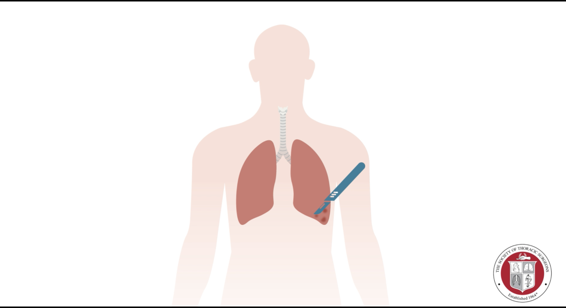 Lung Resection 