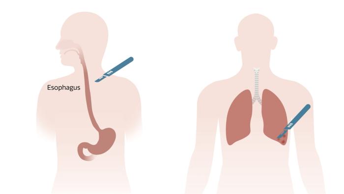 thoracic surgery risk calculators